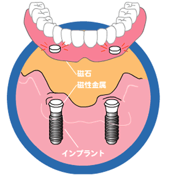 マグネットを利用して義歯を安定