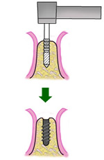 インプラントの埋入手術