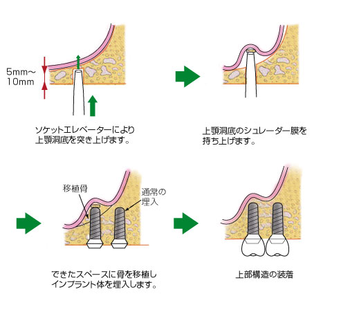 ソケットリフト