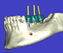 インプラント治療001