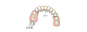 奥歯が数本抜けた場合01