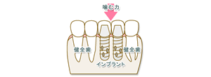 歯が中間で2本抜けた場合02