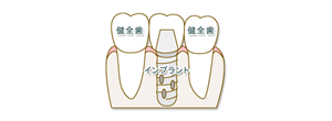 歯が中間で1本抜けた場合02