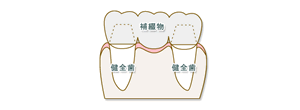 歯が中間で1本抜けた場合01