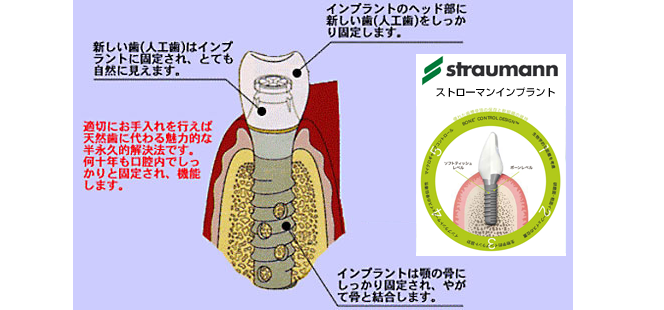 インプラント治療とは