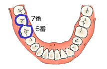 インプラント治療例